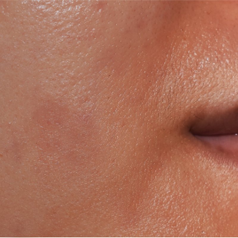 Blemish-Prone Skin