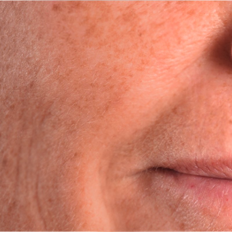 First Lines & Skin Aging