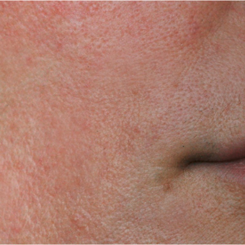 Sensitive Skin & Redness